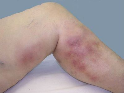Болит нога от щиколотки до колена с внешней стороны