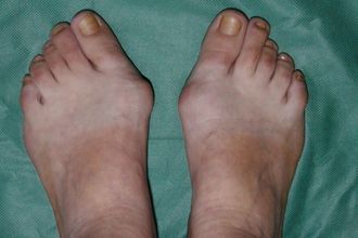 Изображение - Боли в суставах ступни ног лечение bolit-kostochka-na-stope_3