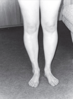 Болят задние мышцы ног в бедренной области больно сесть