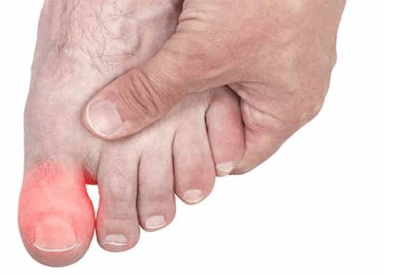 При ходьбе болит сустав на большом пальце ноги лечение