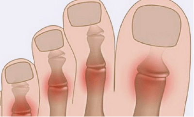 Болит большой палец на ноге при наступании
