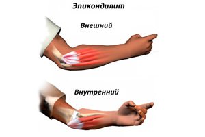 Болит рука в локтевом суставе с внутренней стороны руки