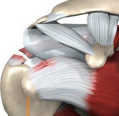 Болят мышцы плеча при отводе руки назад