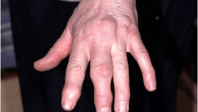 Изображение - Болят суставы средних пальцев рук причины Snimok-ekrana-2017-06-07-v-18.28.07
