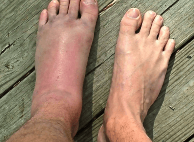 Болит сустав пальца ноги при нажатии