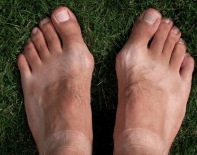 Болит сустав пальца ноги при нажатии