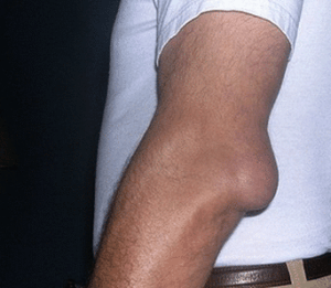 Болит рука в локтевом суставе с внутренней стороны руки