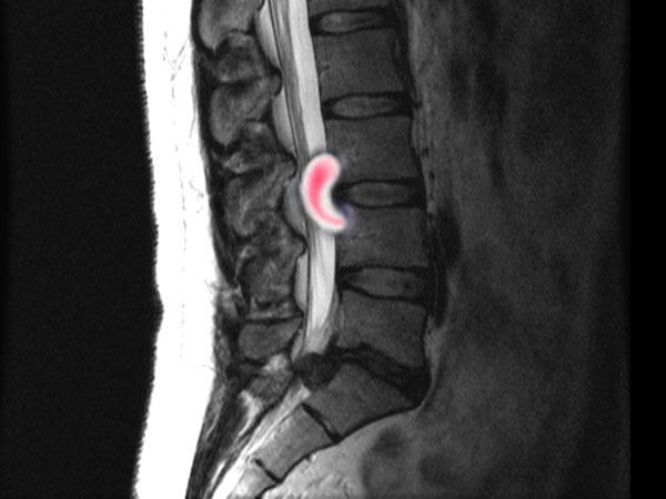 Мр картина остеохондроза пояснично крестцового отдела